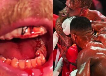Jake Paul hospitalized with fractured Jaw inflicted by Anthony Joshua