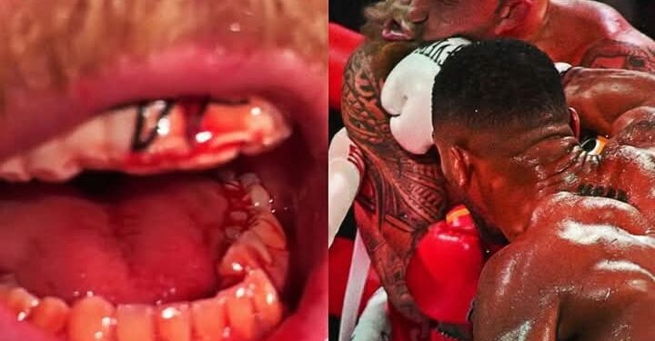 Jake Paul hospitalized with fractured Jaw inflicted by Anthony Joshua